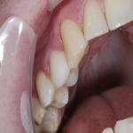 Dental Implants Treatment in Ayres Quay 4