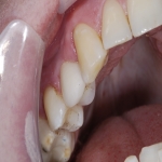 Dental Implants Treatment in Cwmdu 5