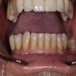 Full Set Tooth Implants in Grove Hill 6