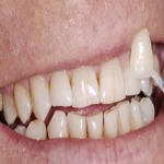 Full Set Tooth Implants in Falkirk 9