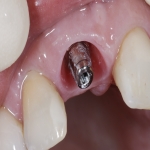 Individual Tooth Implants in Offham 4