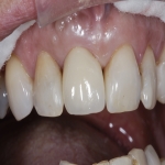 Tooth Implant Prices 10