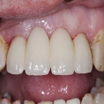 Individual Tooth Implants in Ewhurst Green 6