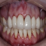 Individual Tooth Implants in Leigh 12