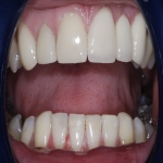 Specialist Denture Fitting in Acton 3