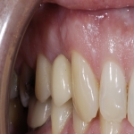 Full Set Tooth Implants in Garden Village 7