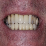 Individual Tooth Implants in White Cross 9