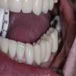 Dental Implants Treatment in Achavandra Muir 3