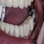 Full Set Tooth Implants in Wellow 8