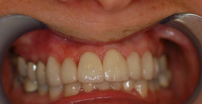 Best Porcelain Veneers