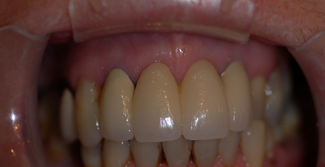 Teeth Implants Support in Enham Alamein