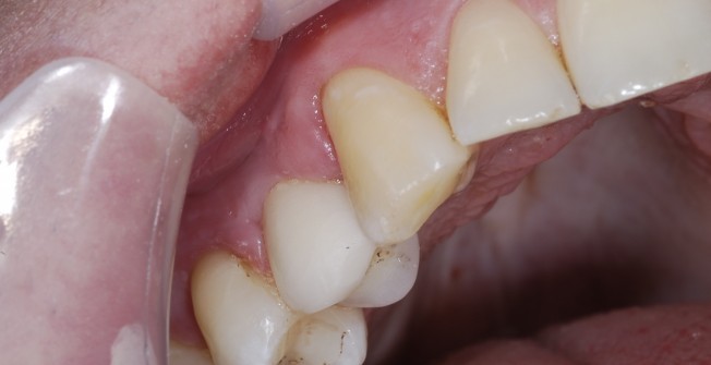 Whole Teeth Services in Enham Alamein