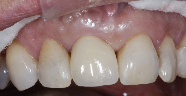 One Tooth Implant in Leigh