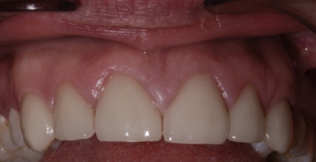 Specialist Tooth Cover in Newtown