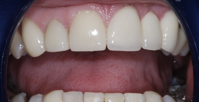 Excellent Dental Bridges in Mount Pleasant