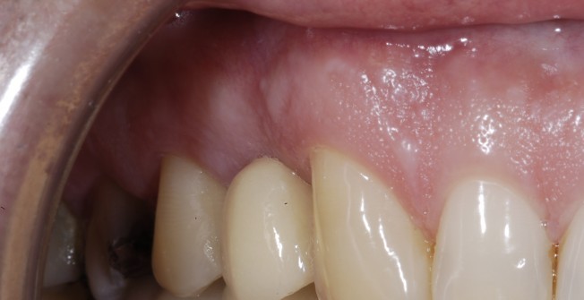 Full Tooth Implants in Ardington Wick